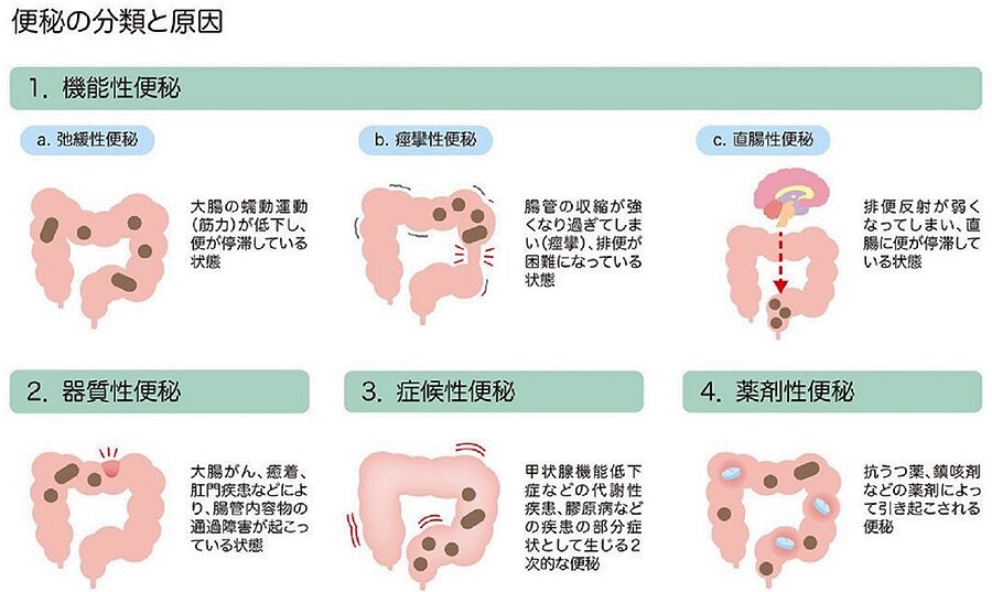 便秘の分類と原因