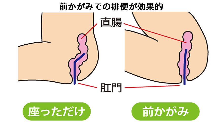 前かがみでの排便が効果的