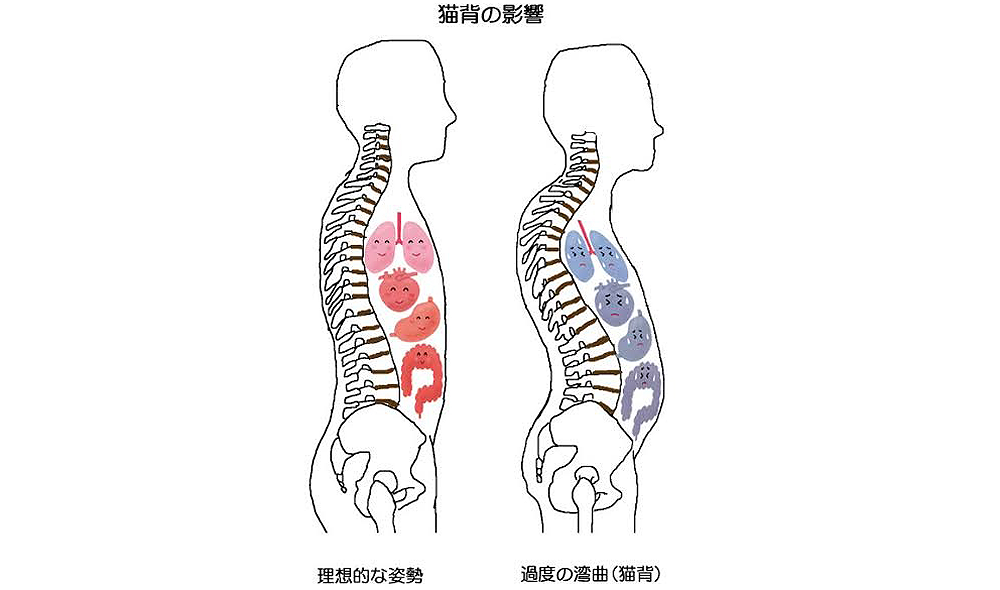 猫背 の影響