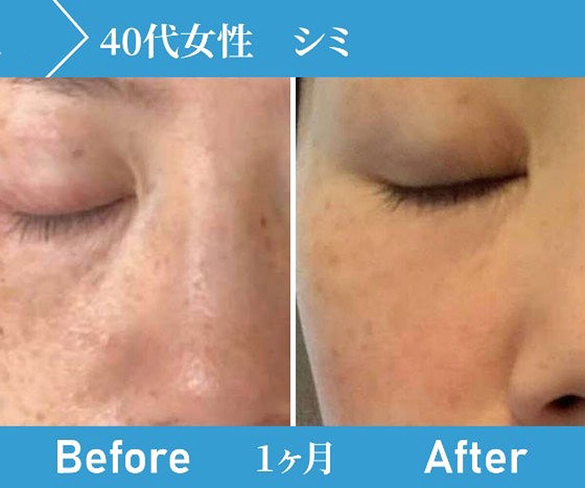 エミューオイルがシミに効く1