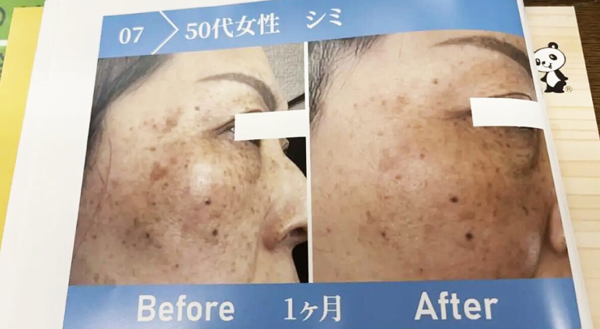 エミューオイルがシミに効く1